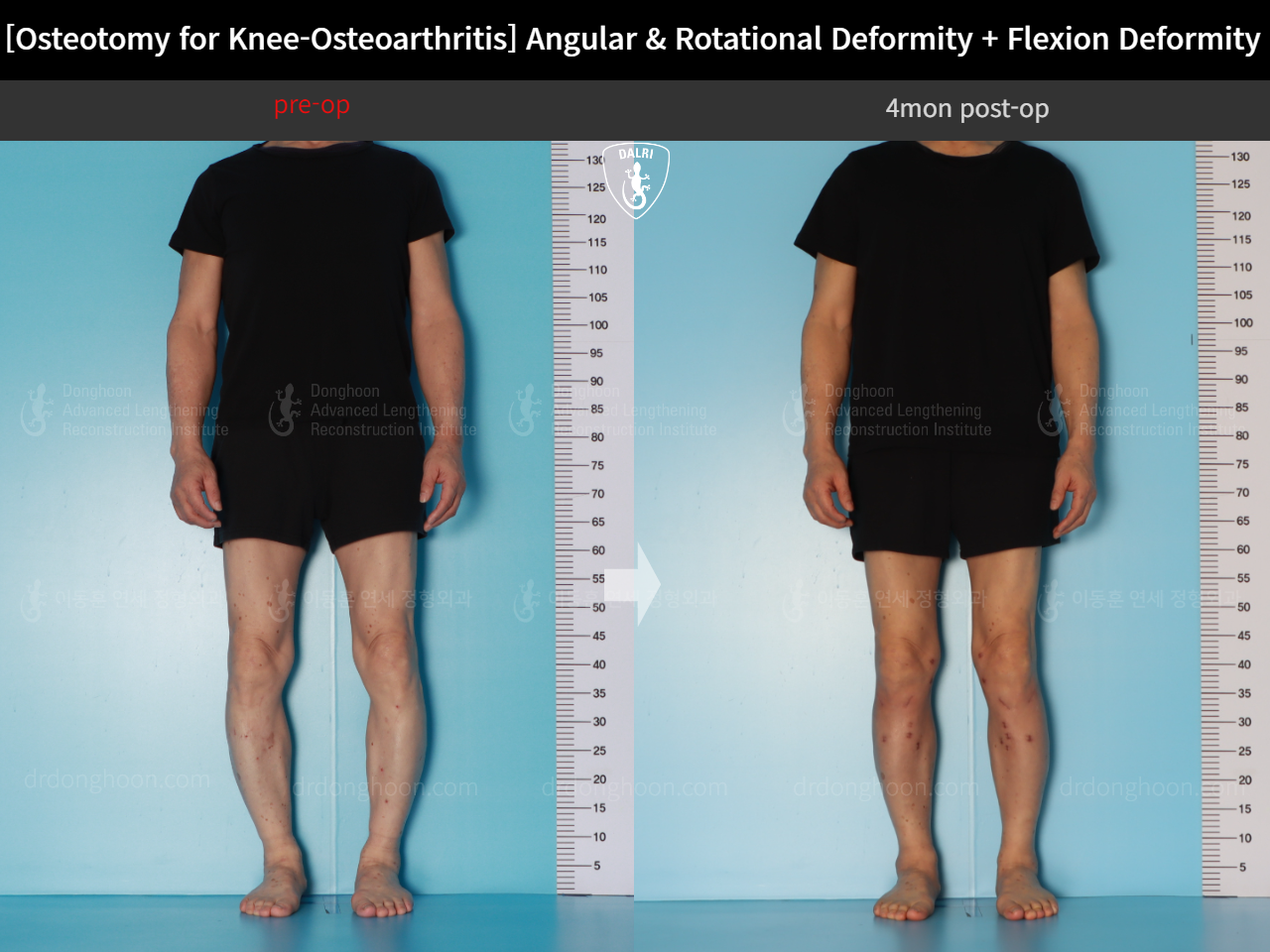 Before and after osteotomy for knee osteoarthritis, case 18162350, image 3, Dr. Donghoon institute (DALRI)