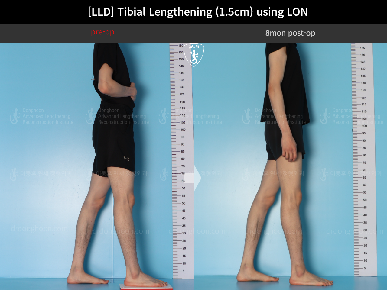 Before and after adult lld, case 18244334, image 3, Dr. Donghoon institute (DALRI)