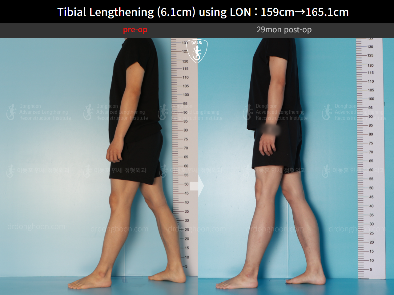 Before and after cll lon, case 16723424, image 3, Dr. Donghoon institute (DALRI)