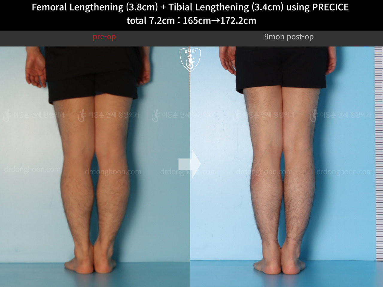 Before and after cll precice, case 14220657, image 8, Dr. Donghoon institute (DALRI)