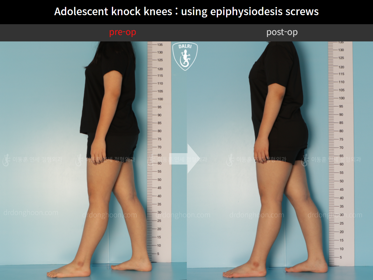 Before and after paediatric & adolescent knock knees, case 11123118, image 3, Dr. Donghoon institute (DALRI)