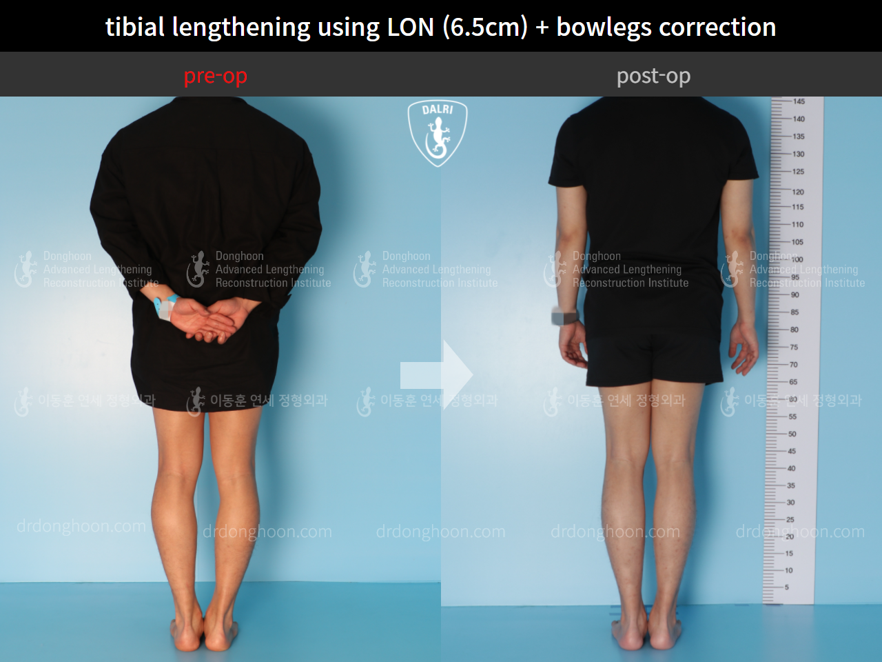 Before and after cll + deformity correction, case 4585639, image 2, Dr. Donghoon institute (DALRI)