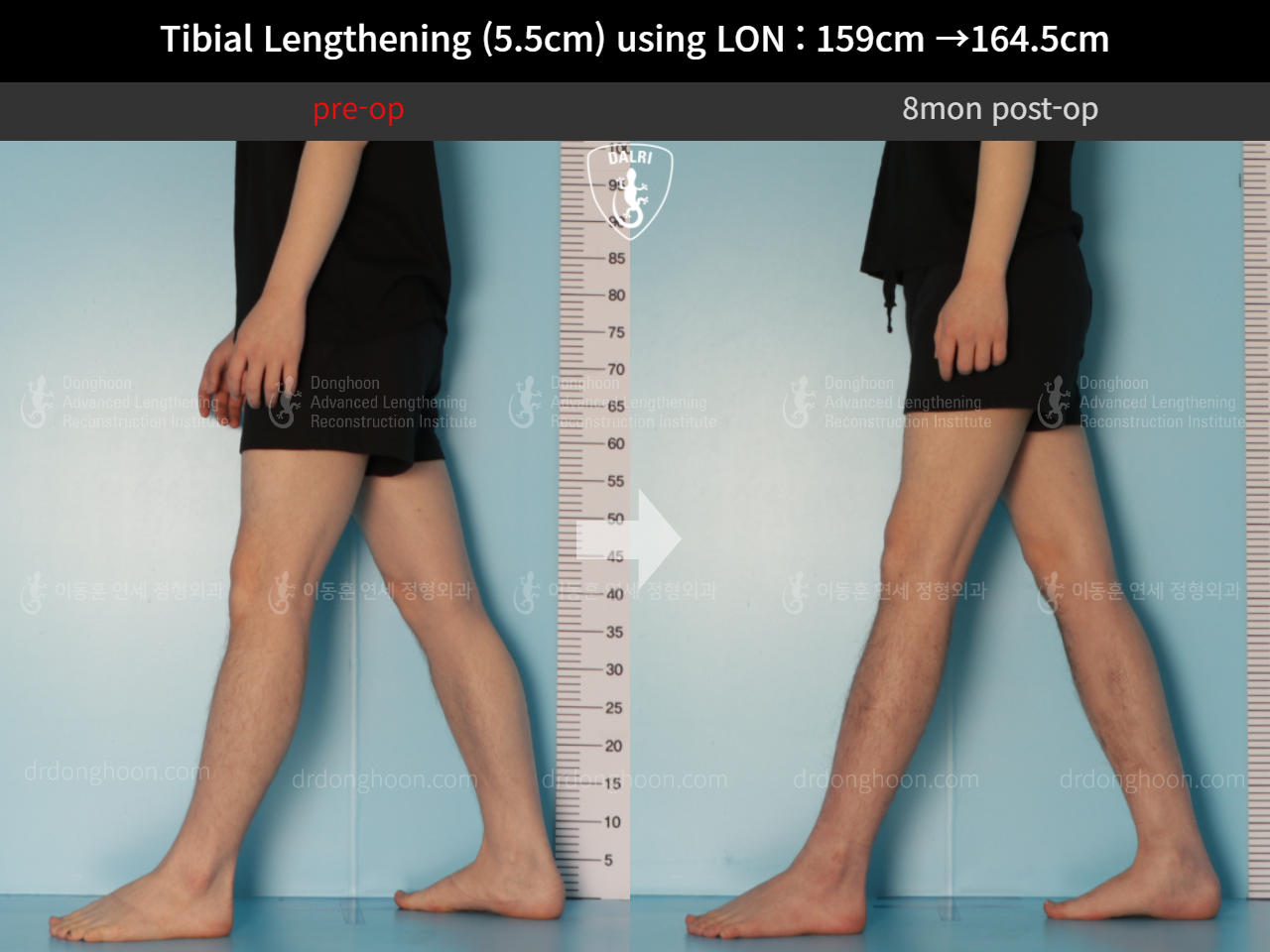 Before and after cll lon, case 10444923, image 7, Dr. Donghoon institute (DALRI)