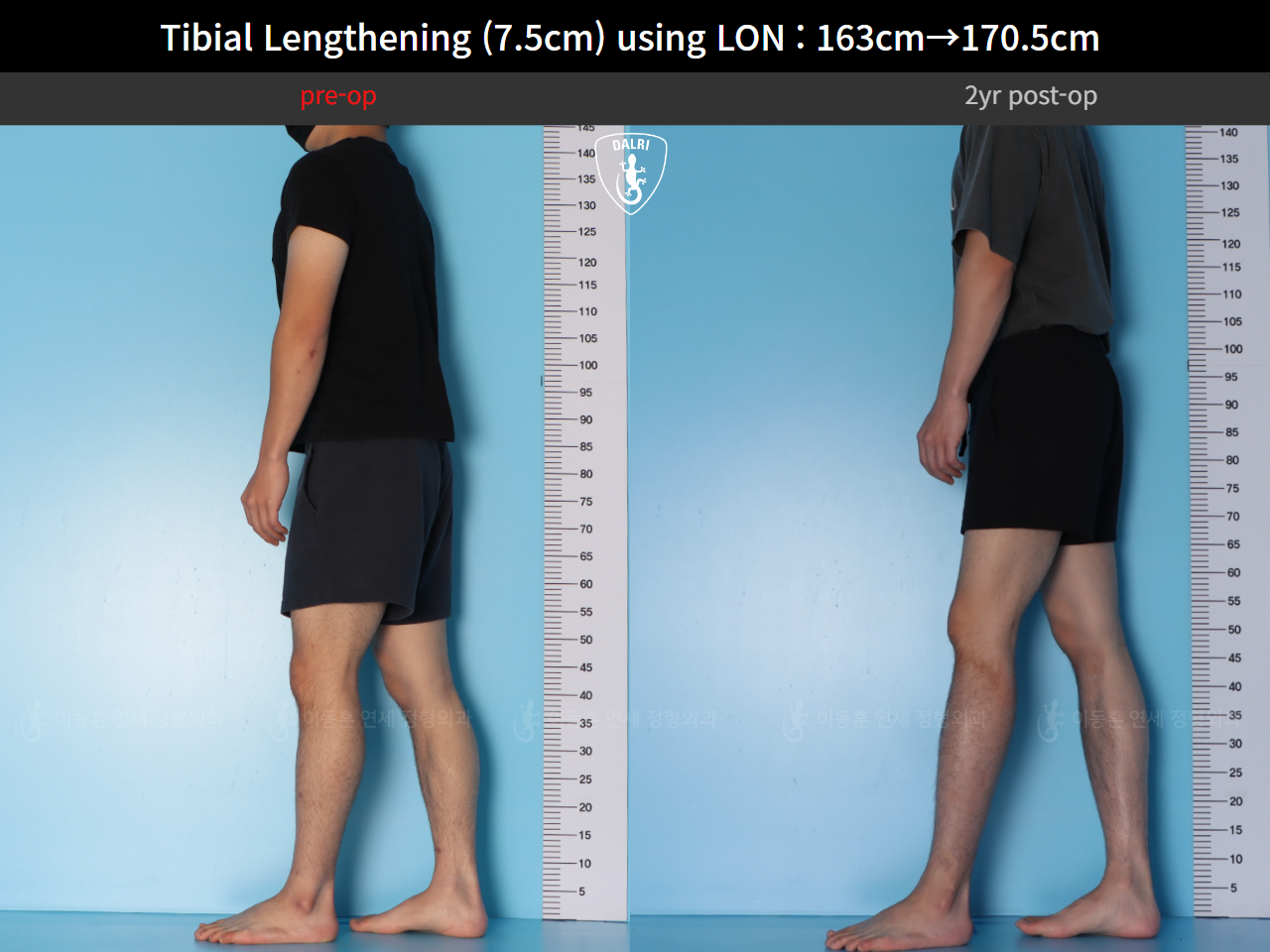 Before and after cll lon, case 125785462, image 5, Dr. Donghoon institute (DALRI)