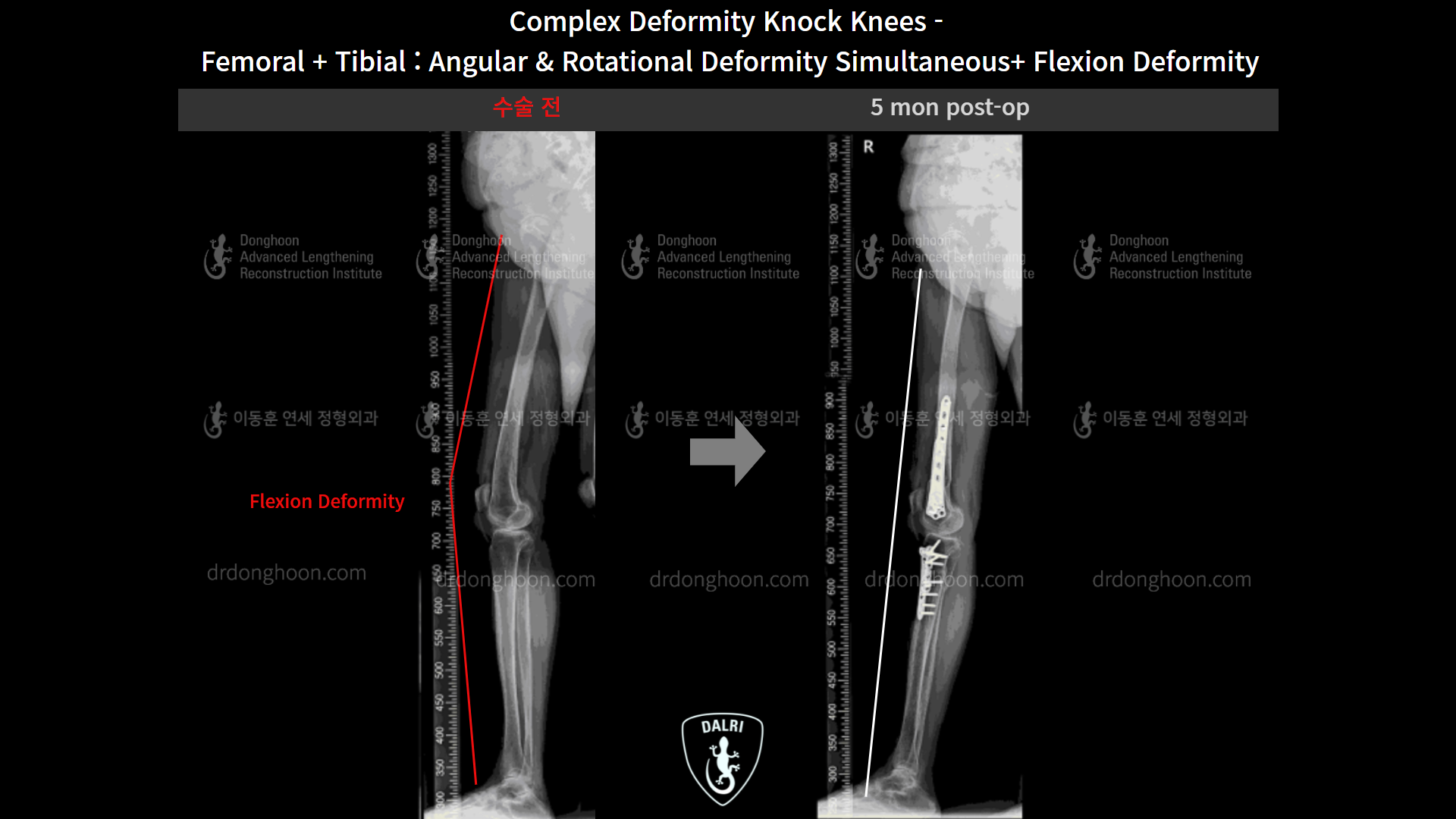 Before and after adult knock knees, case 9153798, image 8, Dr. Donghoon institute (DALRI)