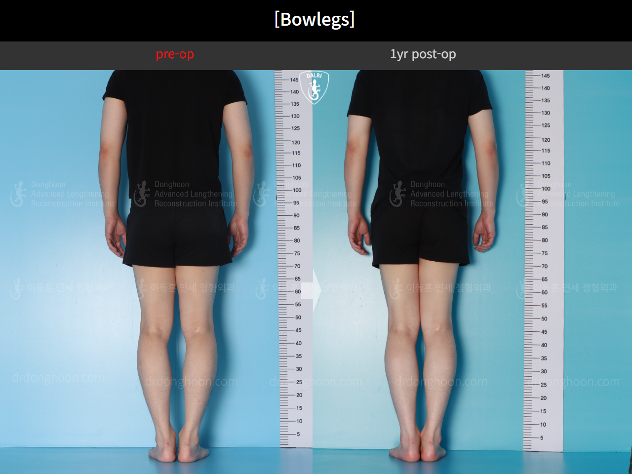 Before and after adult bowlegs, case 16724494, image 3, Dr. Donghoon institute (DALRI)
