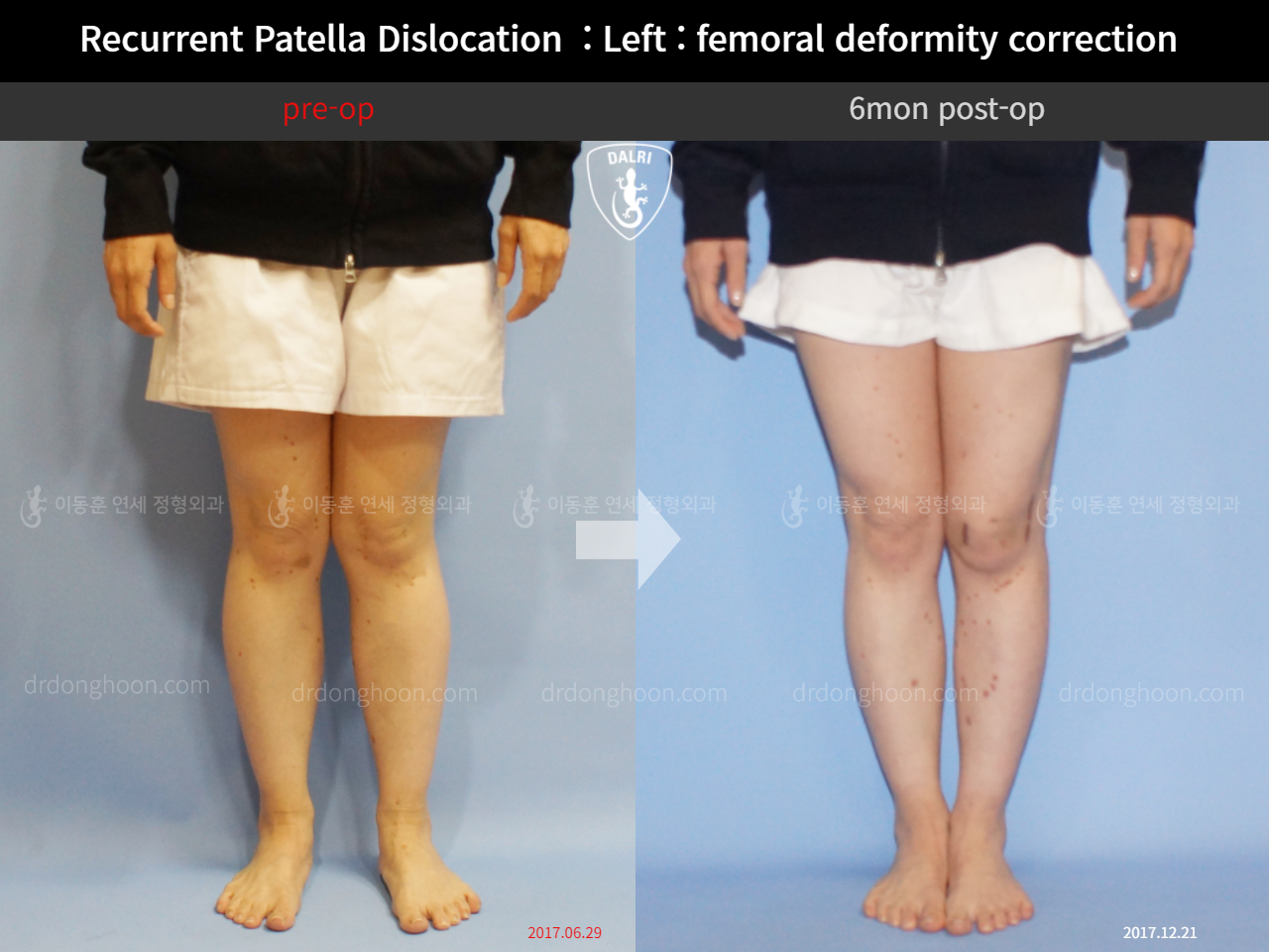 Before and after adult knock knees, case 10546874, image 3, Dr. Donghoon institute (DALRI)