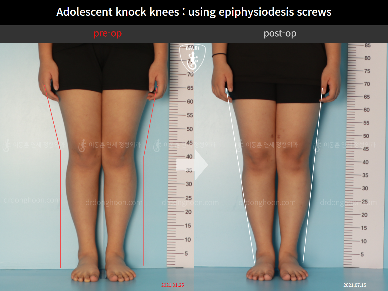 Before and after paediatric & adolescent knock knees, case 11123118, image 5, Dr. Donghoon institute (DALRI)