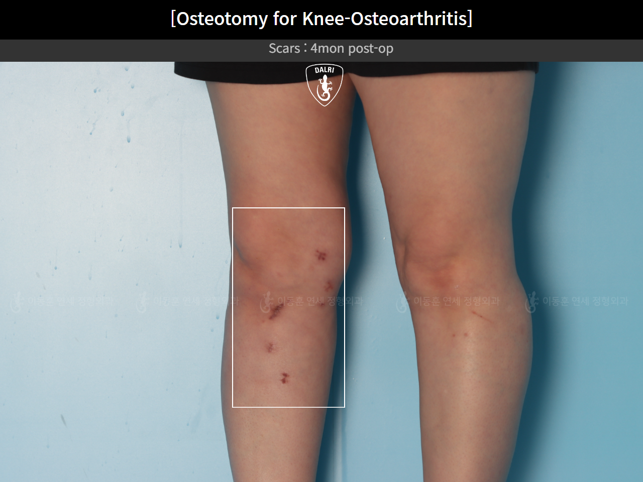 Before and after osteotomy for knee osteoarthritis, case 39778471, image 7, Dr. Donghoon institute (DALRI)