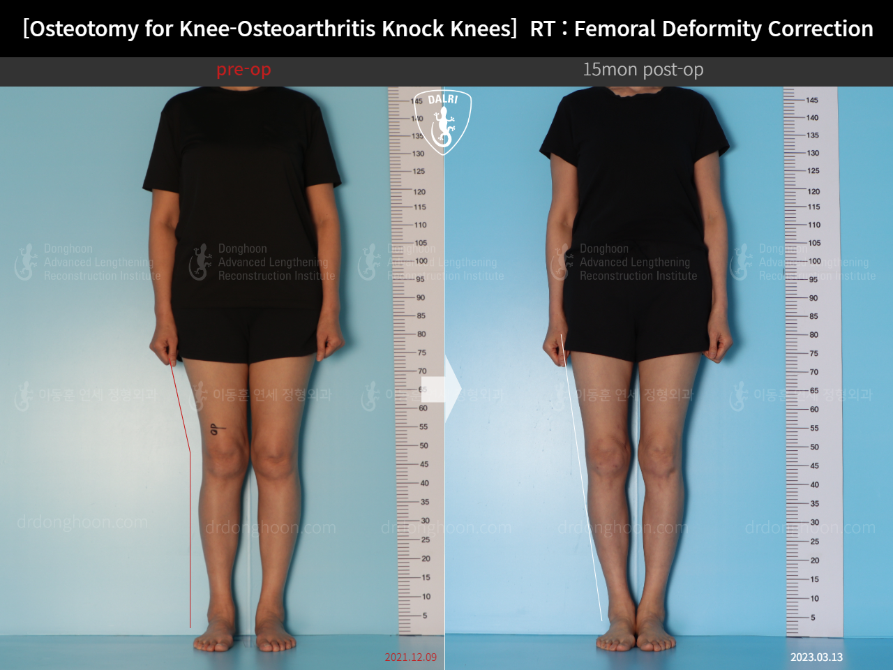 Before and after osteotomy for knee osteoarthritis, case 14462707, image 2, Dr. Donghoon institute (DALRI)