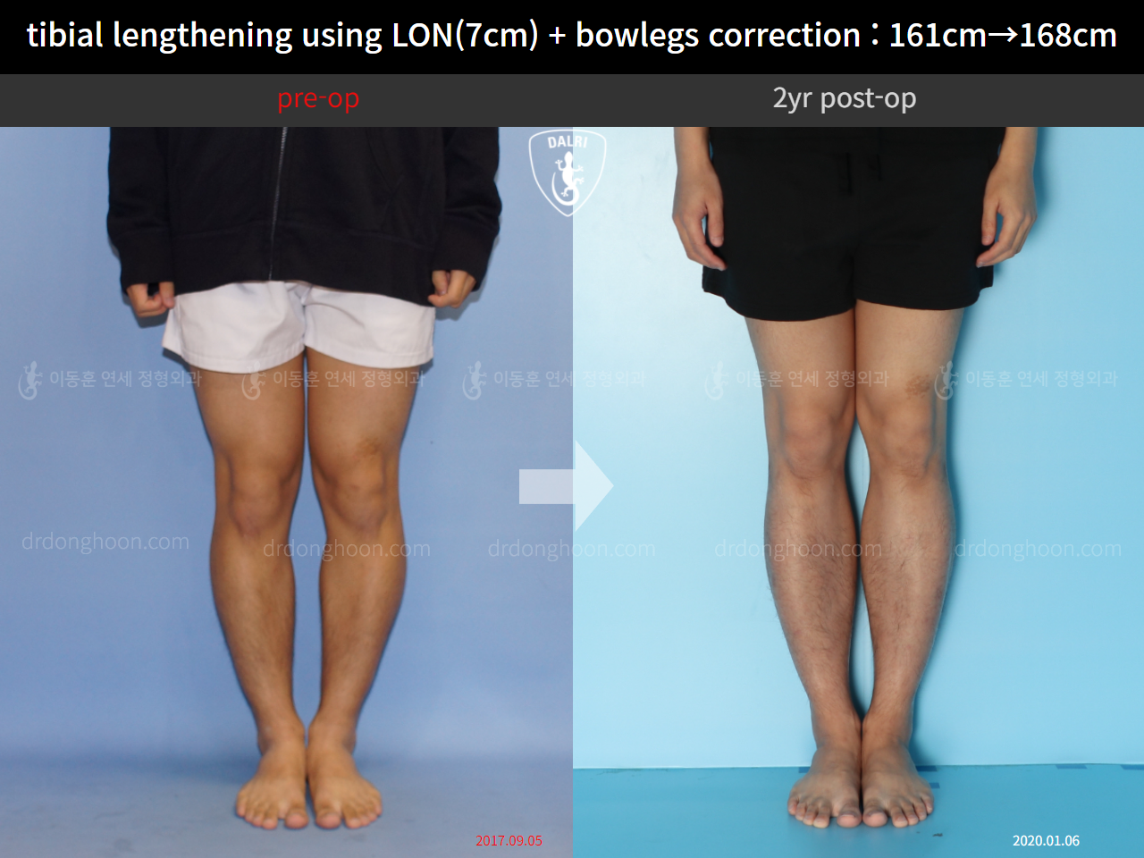 Before and after cll + deformity correction, case 10400088, image 5, Dr. Donghoon institute (DALRI)