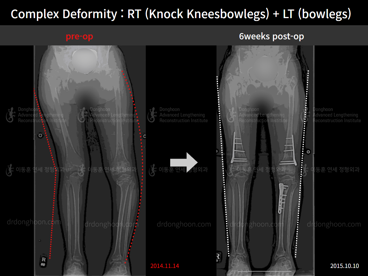 Before and after paediatric & adolescent knock knees, case 8618379, image 6, Dr. Donghoon institute (DALRI)
