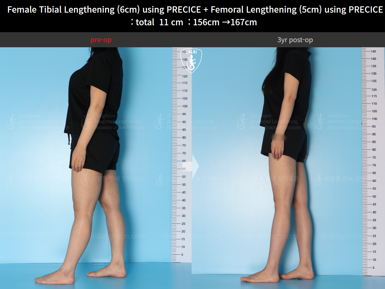 Before and after cll precice, case 24986271, image 4, Dr. Donghoon institute (DALRI)