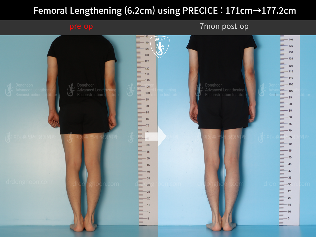 Before and after cll precice, case 13325833, image 3, Dr. Donghoon institute (DALRI)