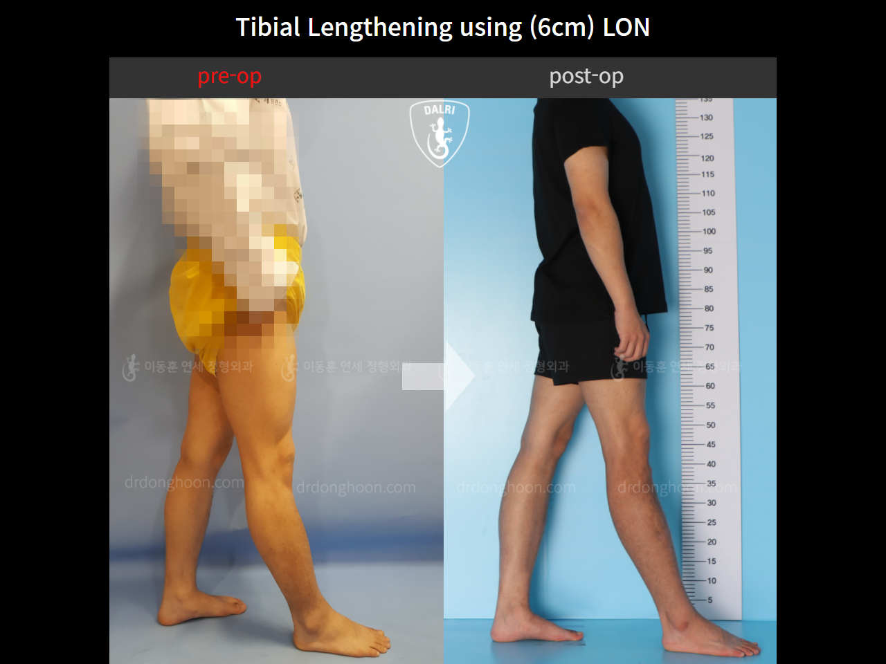Before and after cll lon, case 11087271, image 3, Dr. Donghoon institute (DALRI)