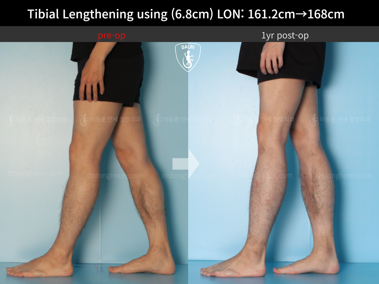 Before and after cll lon, case 13633878, image 9, Dr. Donghoon institute (DALRI)