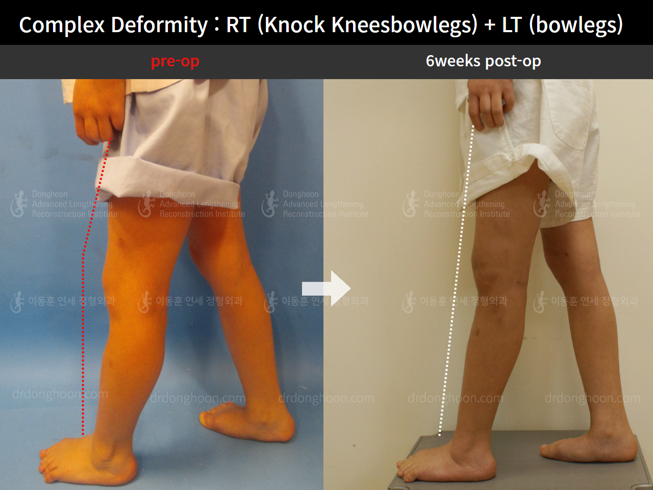 Before and after paediatric & adolescent knock knees, case 8618314, image 4, Dr. Donghoon institute (DALRI)