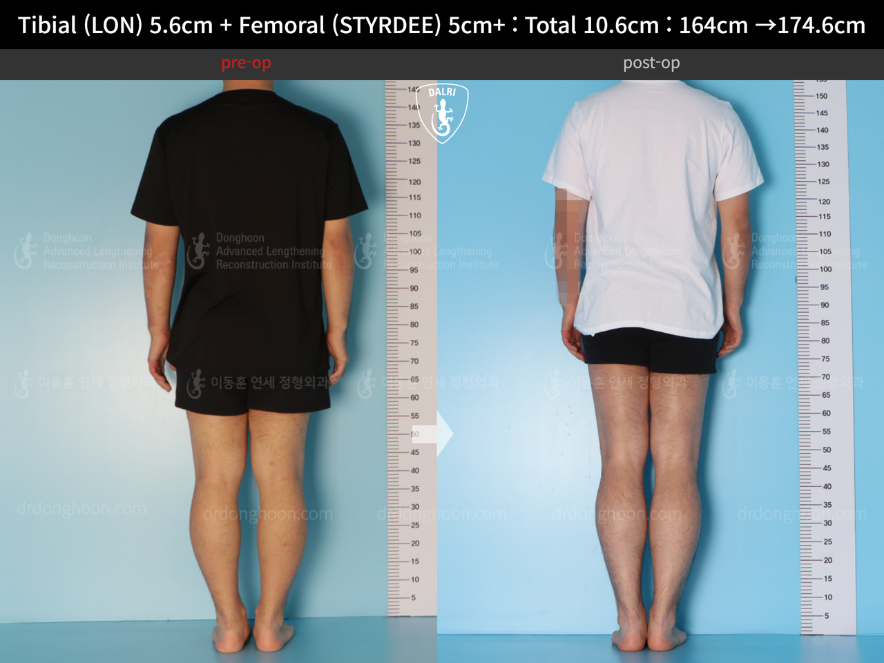 Before and after cll precice, case 13942494, image 6, Dr. Donghoon institute (DALRI)