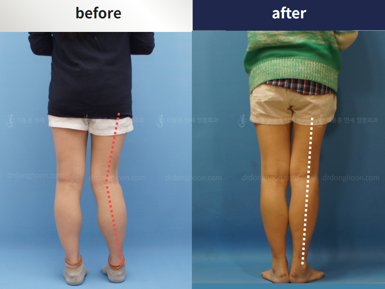 Before and after post-trauma deformity, case 4357134, image 3, Dr. Donghoon institute (DALRI)