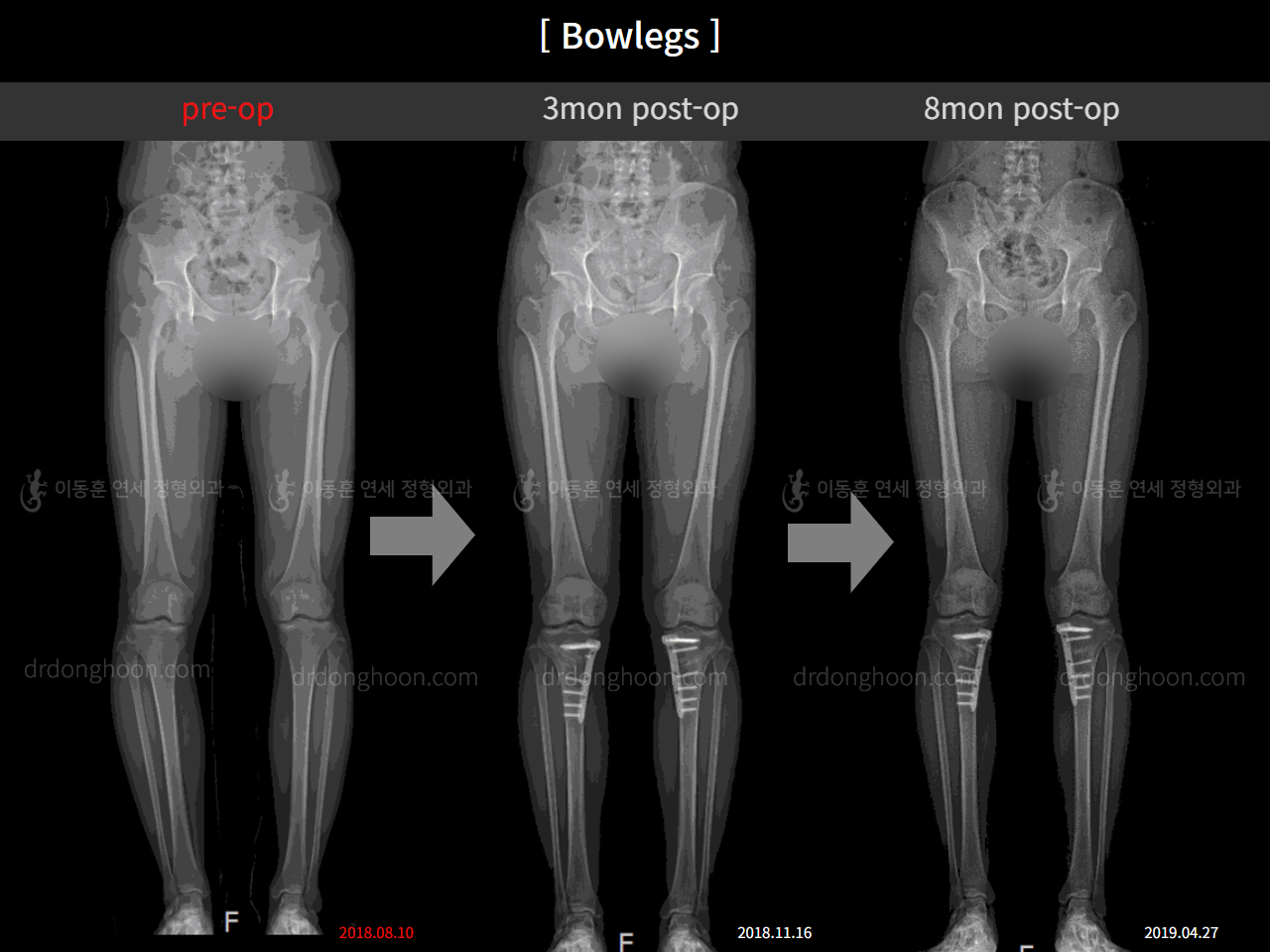 Before and after adult bowlegs, case 4311053, image 7, Dr. Donghoon institute (DALRI)