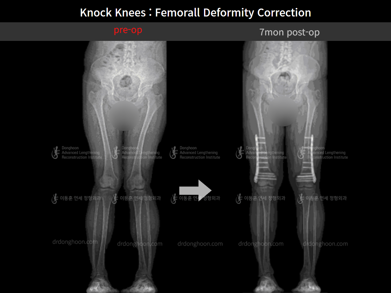 Before and after adult knock knees, case 8821218, image 7, Dr. Donghoon institute (DALRI)