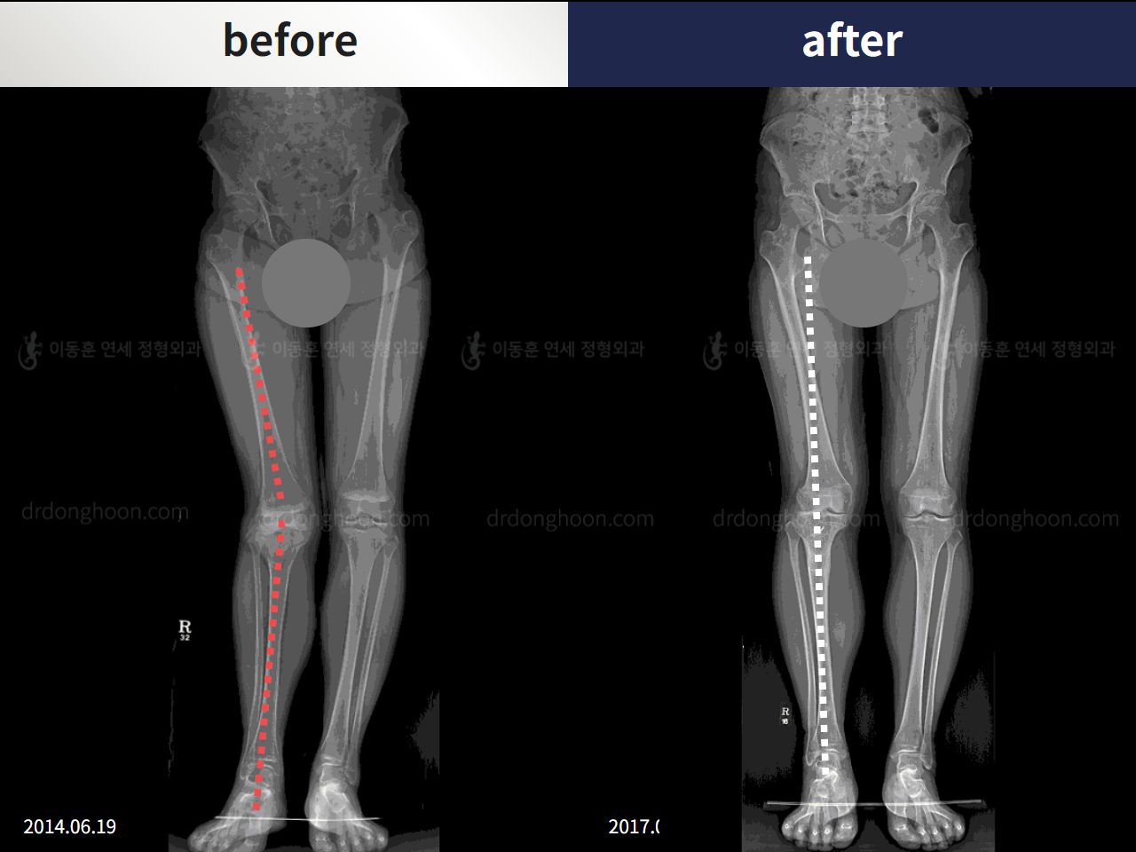 Before and after post-trauma deformity, case 4357134, image 2, Dr. Donghoon institute (DALRI)