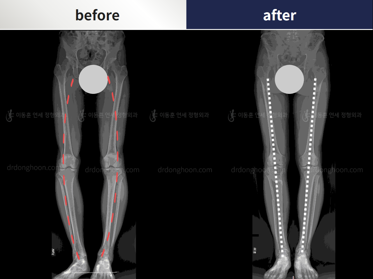 Before and after complex deformity, case 4251637, image 1, Dr. Donghoon institute (DALRI)