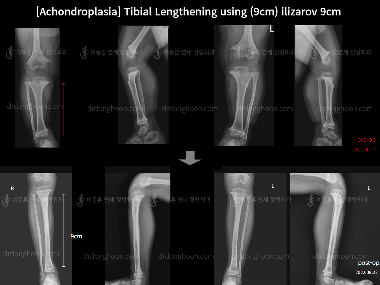 Before and after paediatric congenital condition, case 14542054, image 5, Dr. Donghoon institute (DALRI)