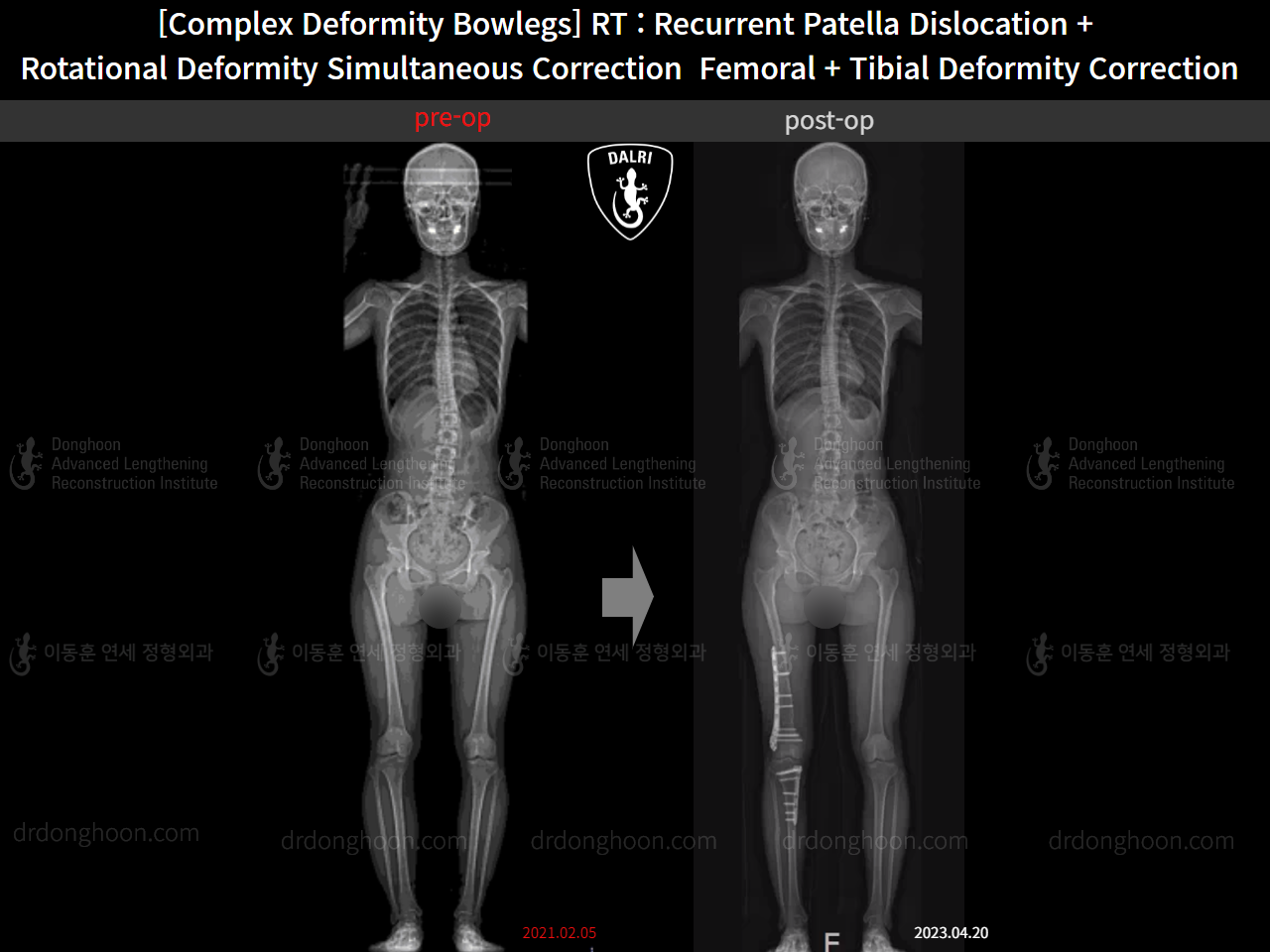Before and after complex deformity, case 14960898, image 9, Dr. Donghoon institute (DALRI)