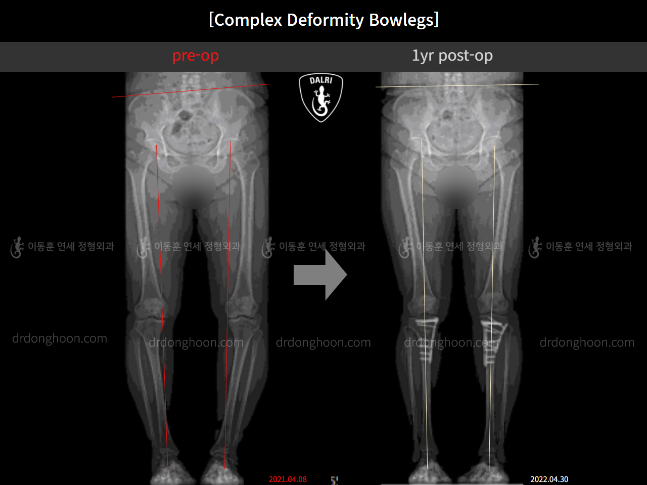 Before and after complex deformity, case 11339608, image 9, Dr. Donghoon institute (DALRI)
