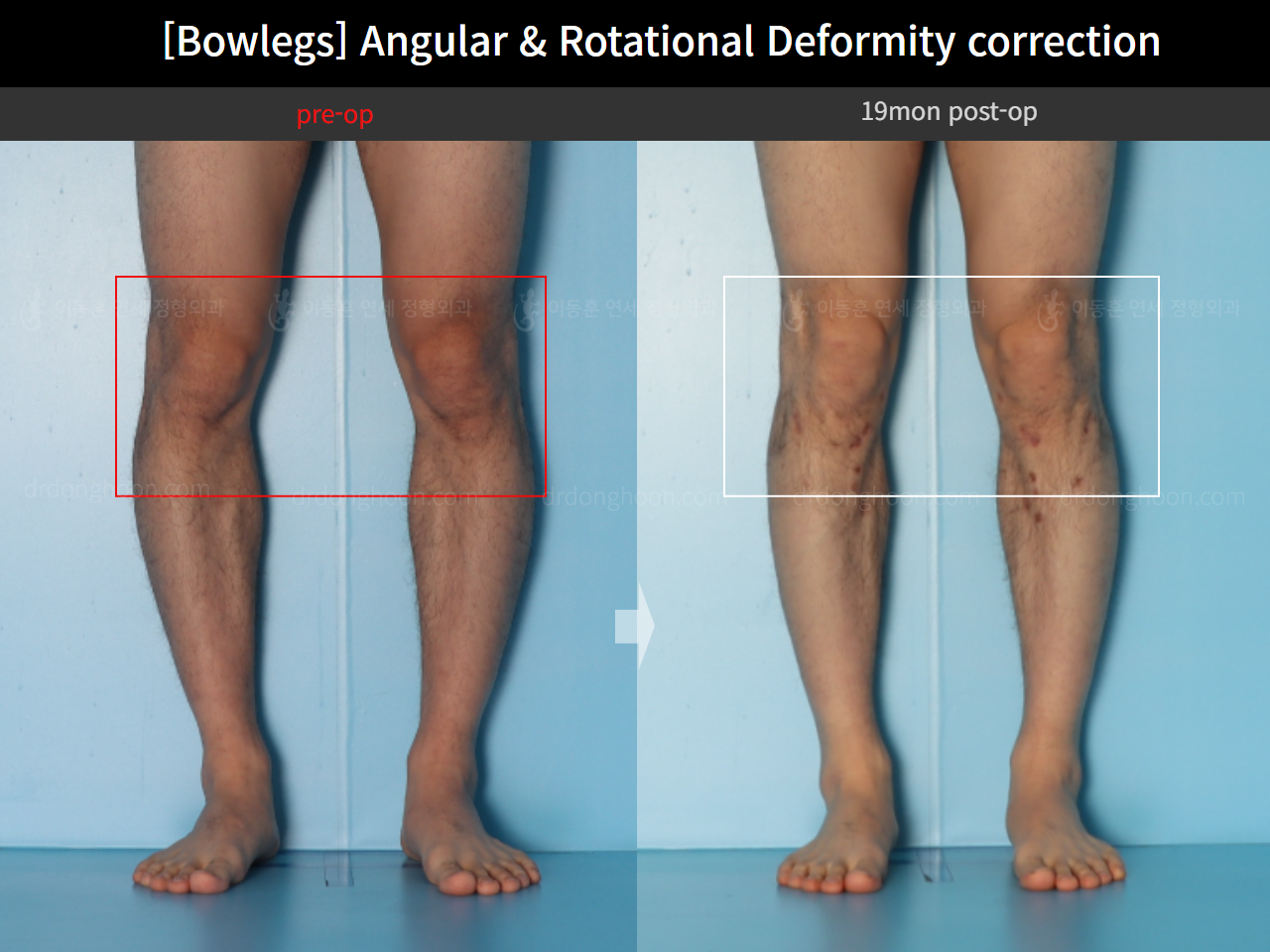 Before and after adult bowlegs, case 18306379, image 11, Dr. Donghoon institute (DALRI)