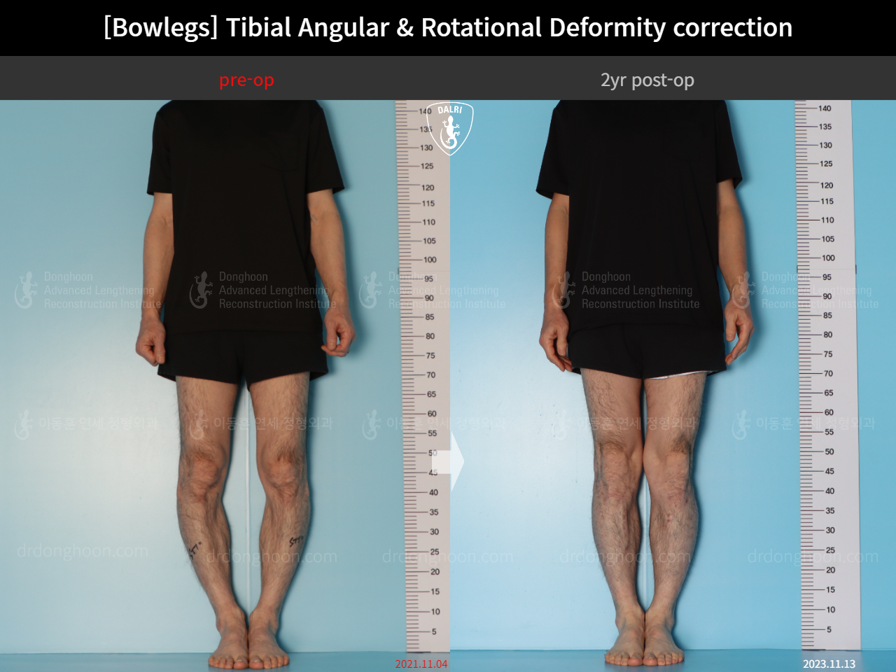 Before and after adult bowlegs, case 16933272, image 3, Dr. Donghoon institute (DALRI)
