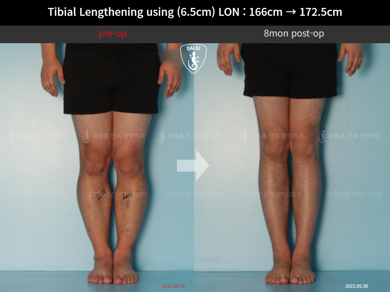 Before and after cll lon, case 11767706, image 4, Dr. Donghoon institute (DALRI)