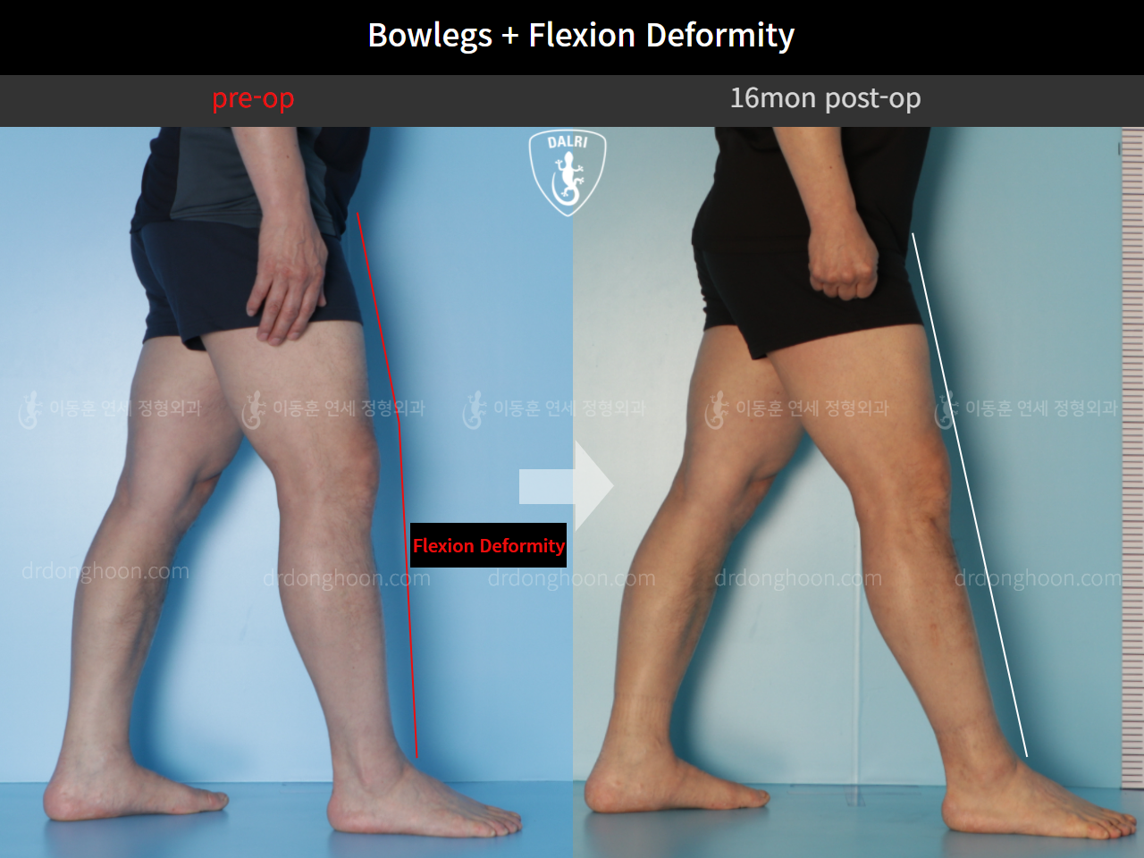 Before and after adult bowlegs, case 10451182, image 6, Dr. Donghoon institute (DALRI)