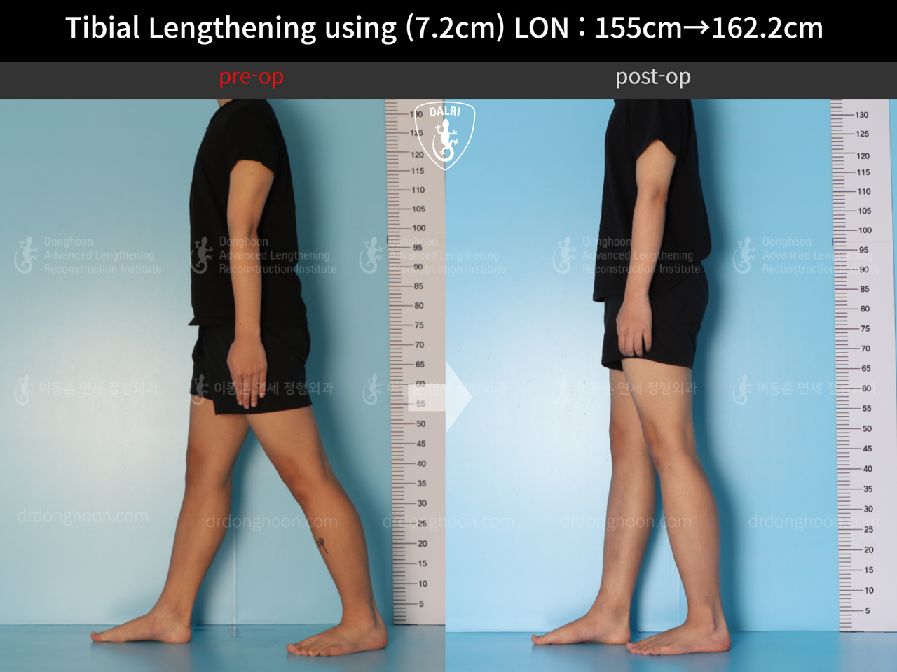 Before and after cll lon, case 13635674, image 4, Dr. Donghoon institute (DALRI)