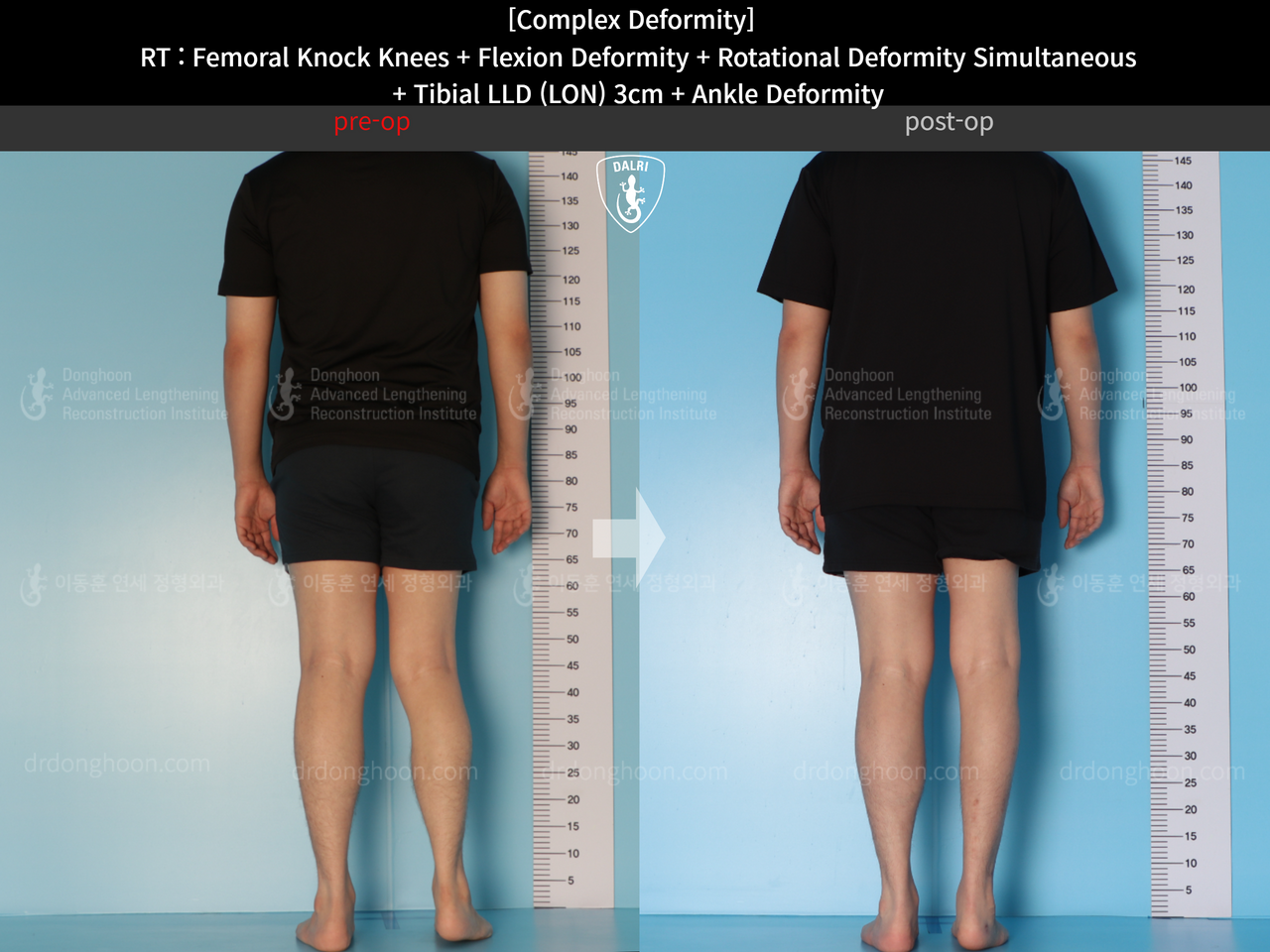 Before and after adult lld, case 14286604, image 4, Dr. Donghoon institute (DALRI)
