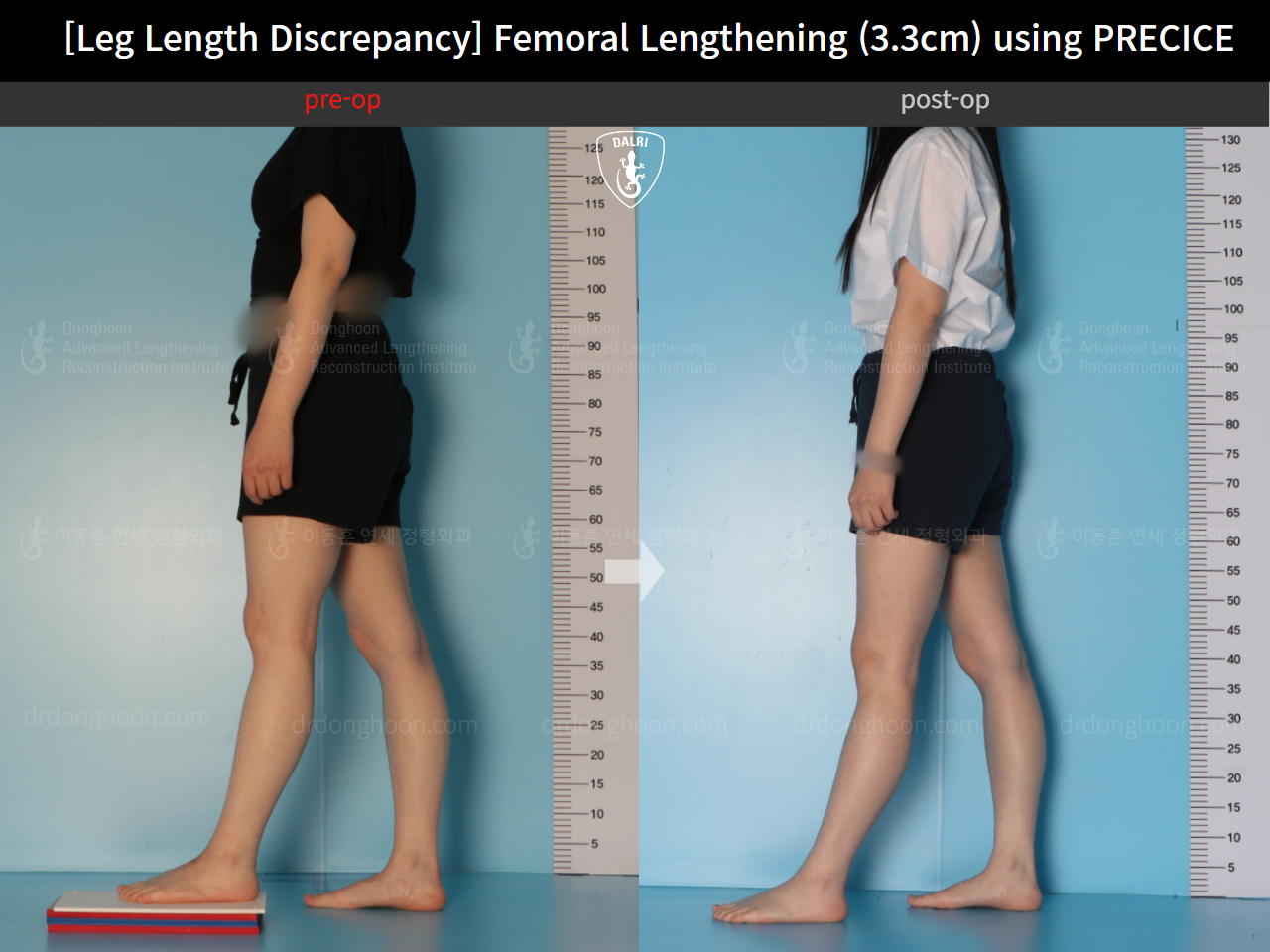 Before and after adult lld, case 22355841, image 3, Dr. Donghoon institute (DALRI)