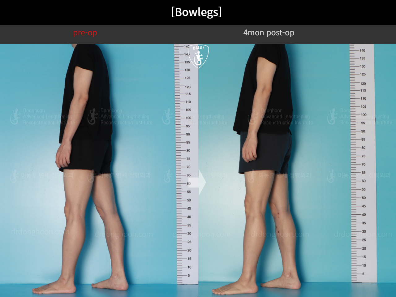 Before and after adult bowlegs, case 17962599, image 7, Dr. Donghoon institute (DALRI)