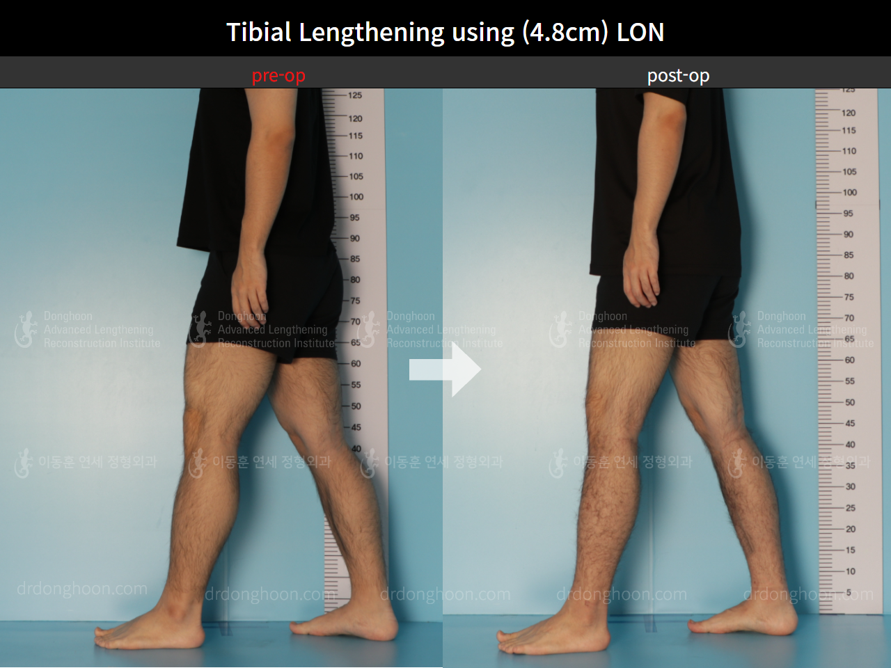 Before and after cll lon, case 8826653, image 4, Dr. Donghoon institute (DALRI)