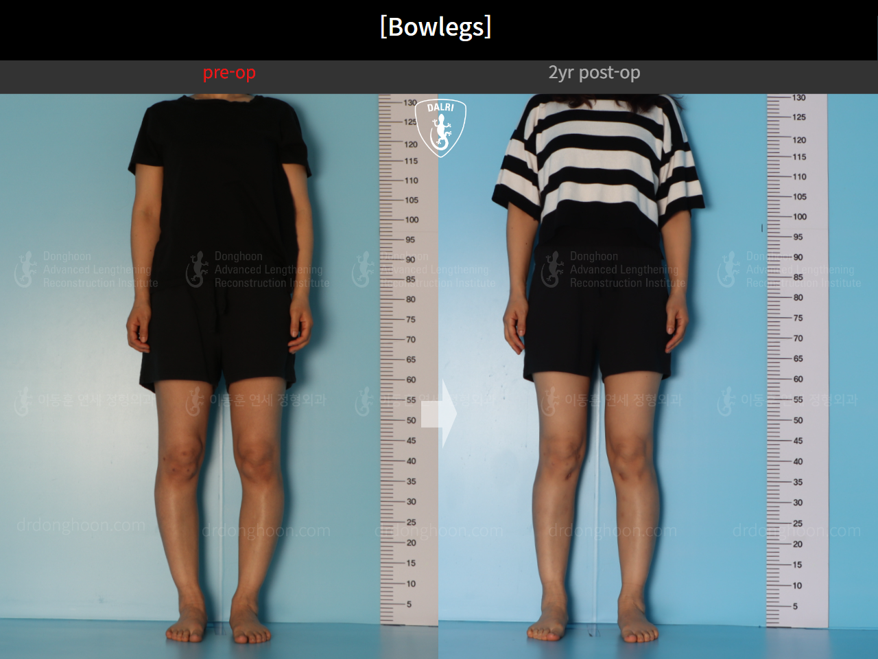 Before and after adult bowlegs, case 20942169, image 3, Dr. Donghoon institute (DALRI)