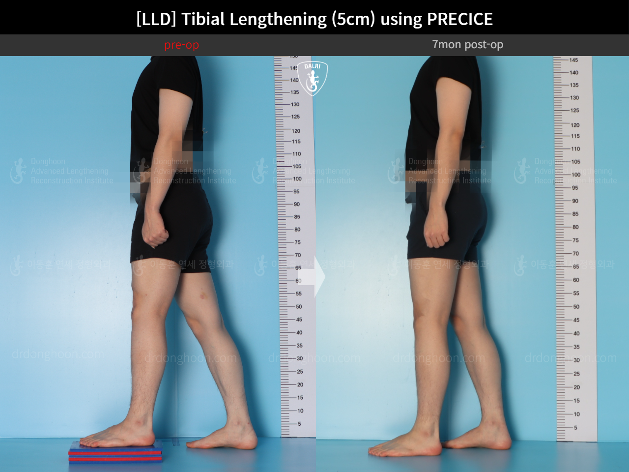 Before and after adult lld, case 18471613, image 3, Dr. Donghoon institute (DALRI)