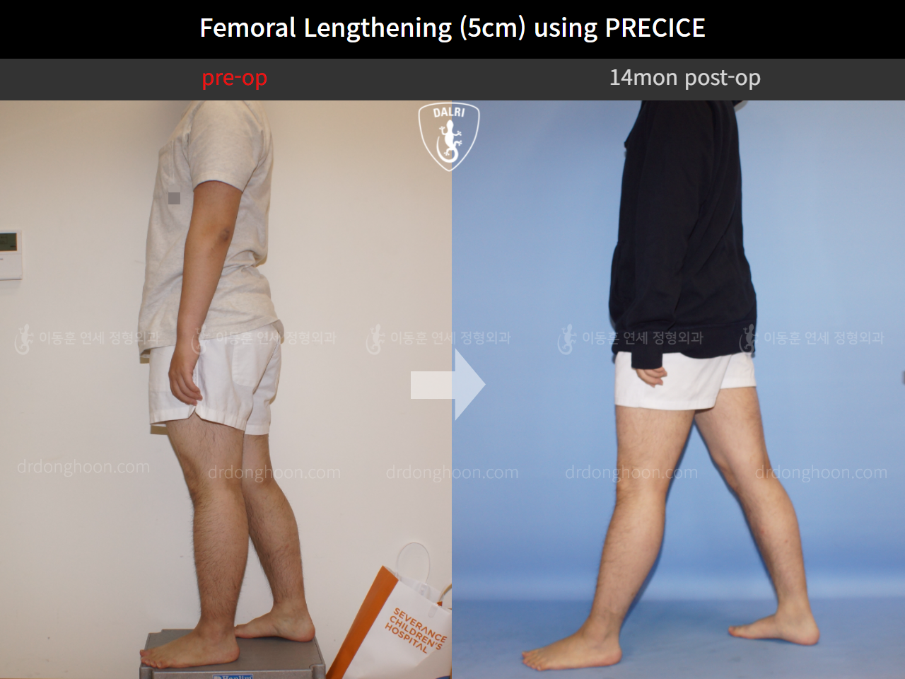 Before and after cll precice, case 4323249, image 3, Dr. Donghoon institute (DALRI)