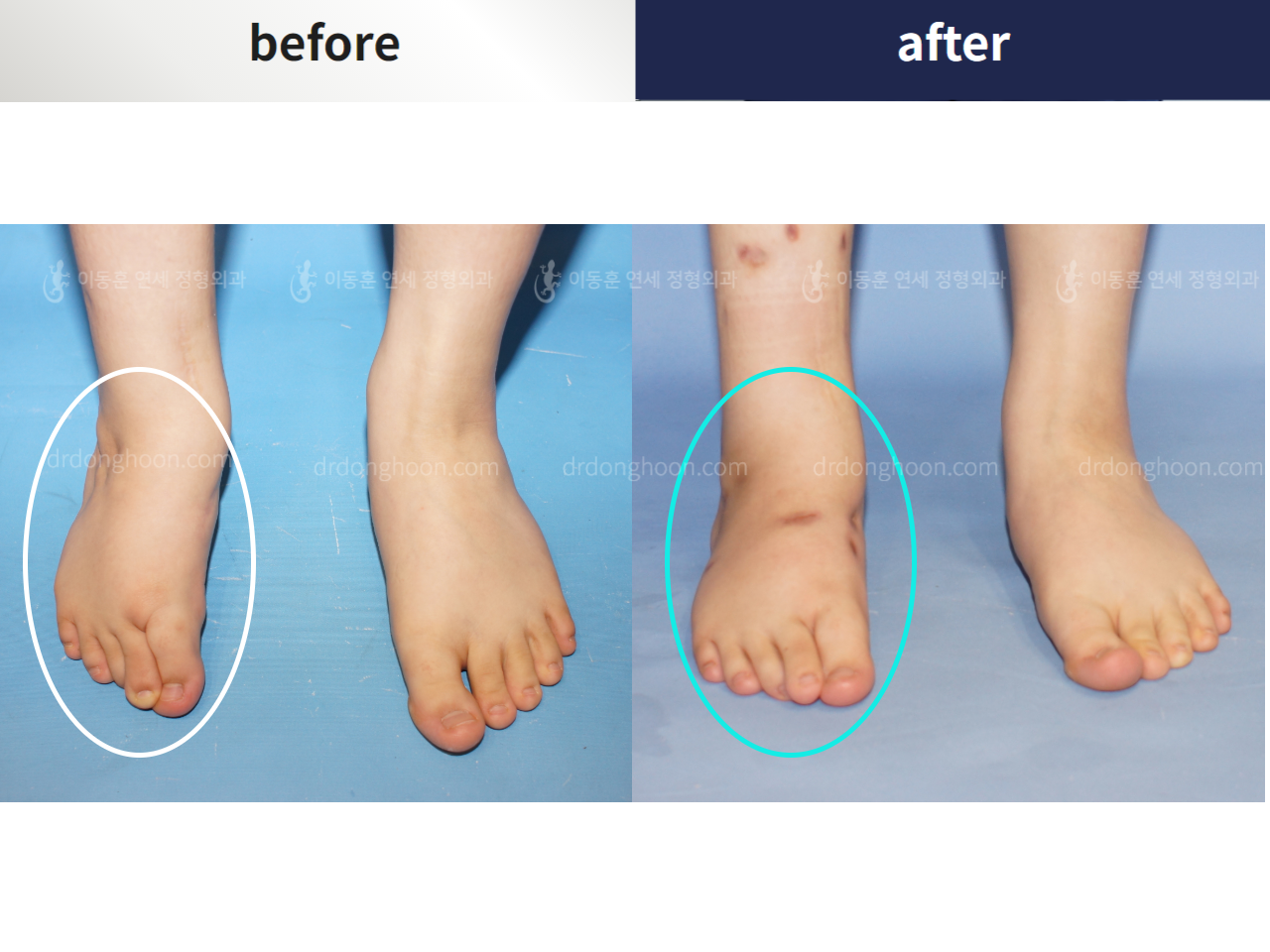 Before and after foot & ankle deformity, case 4367962, image 2, Dr. Donghoon institute (DALRI)