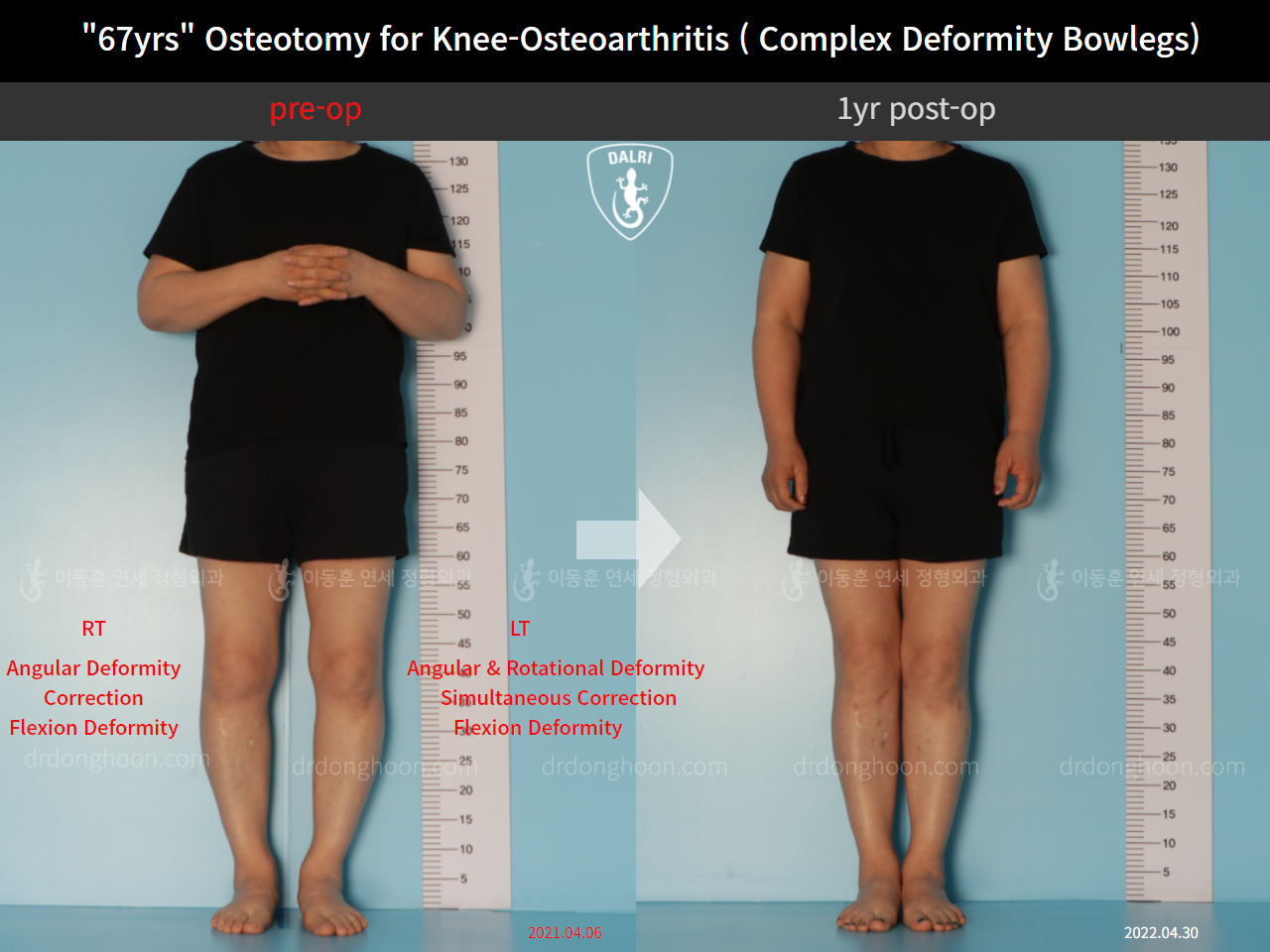 Before and after adult bowlegs, case 11339434, image 1, Dr. Donghoon institute (DALRI)