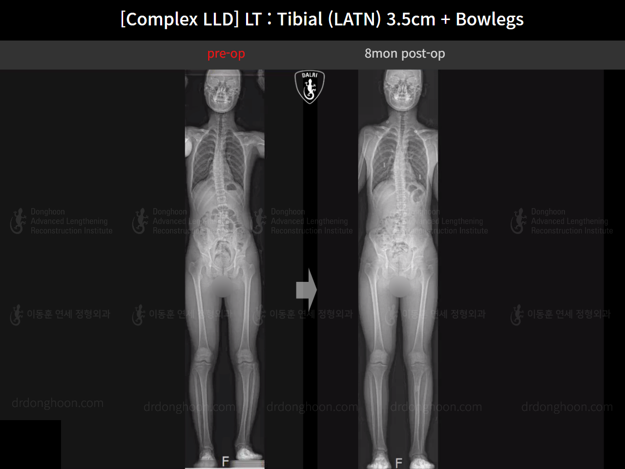 Before and after complex deformity, case 16724288, image 9, Dr. Donghoon institute (DALRI)