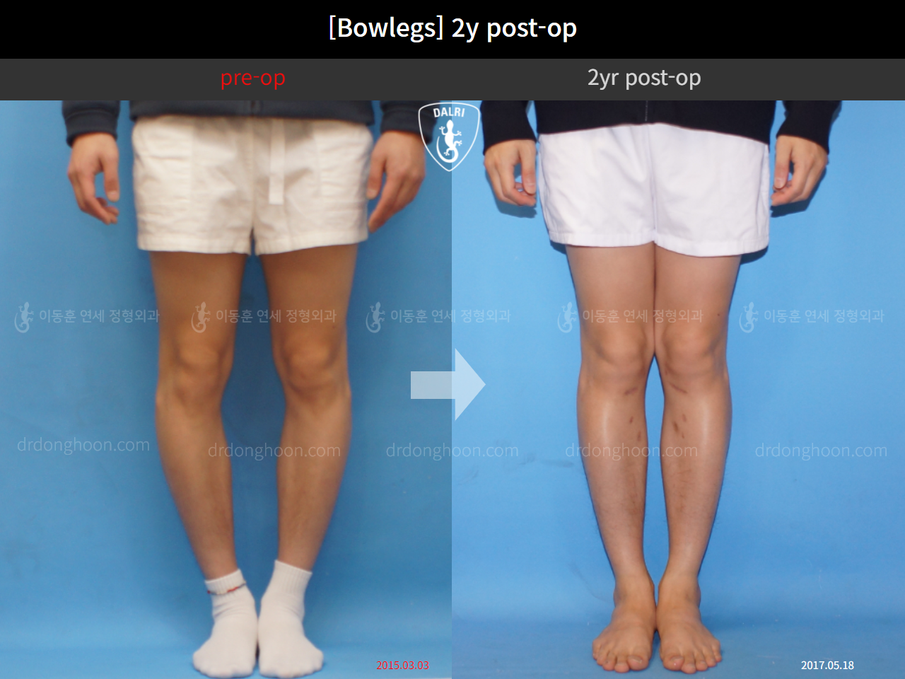 Before and after adult bowlegs, case 4311131, image 3, Dr. Donghoon institute (DALRI)