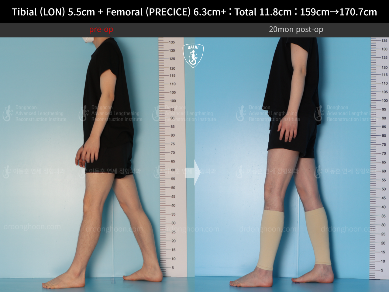 Before and after cll precice, case 14390078, image 6, Dr. Donghoon institute (DALRI)