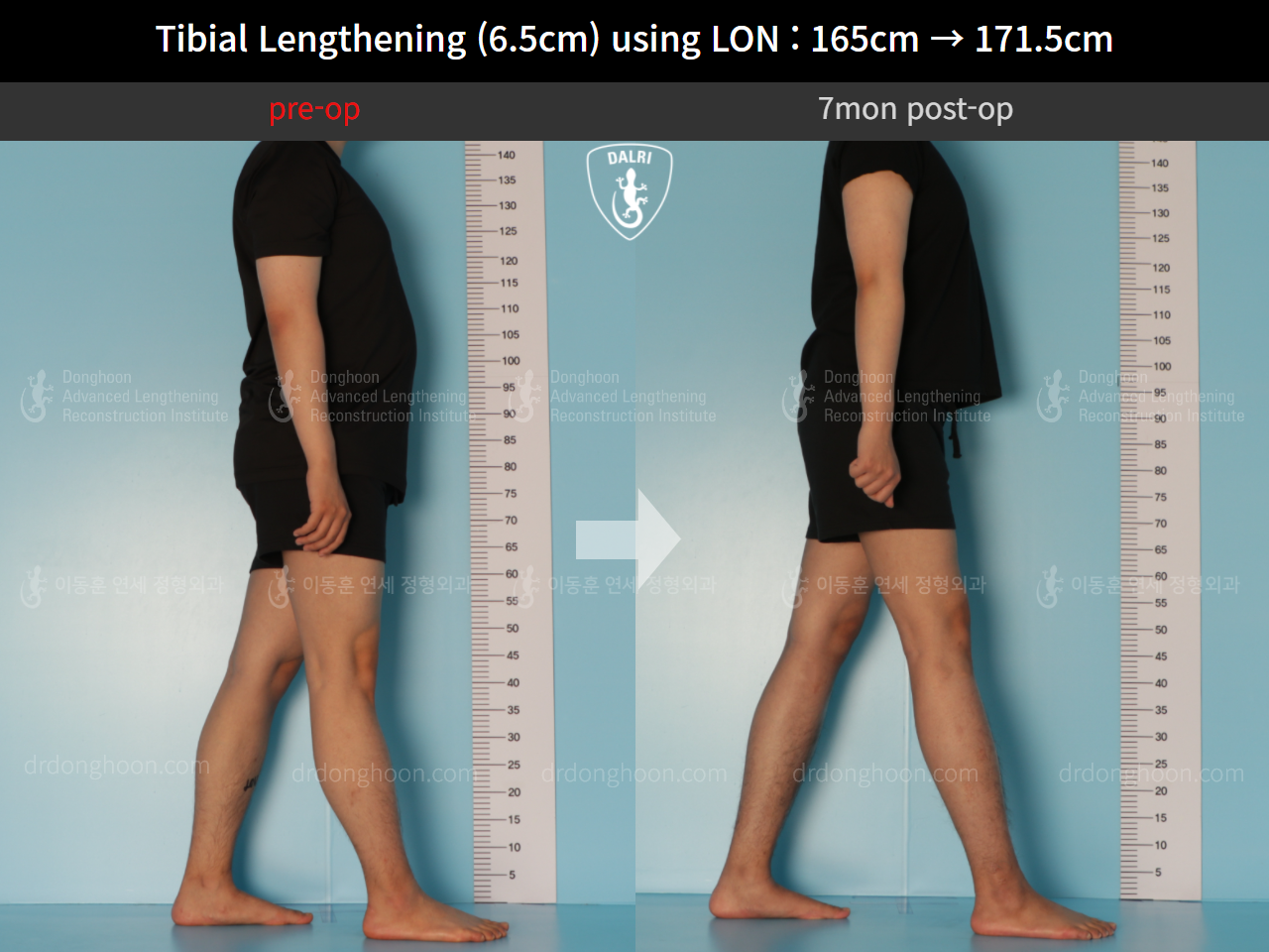 Before and after cll lon, case 10388000, image 3, Dr. Donghoon institute (DALRI)