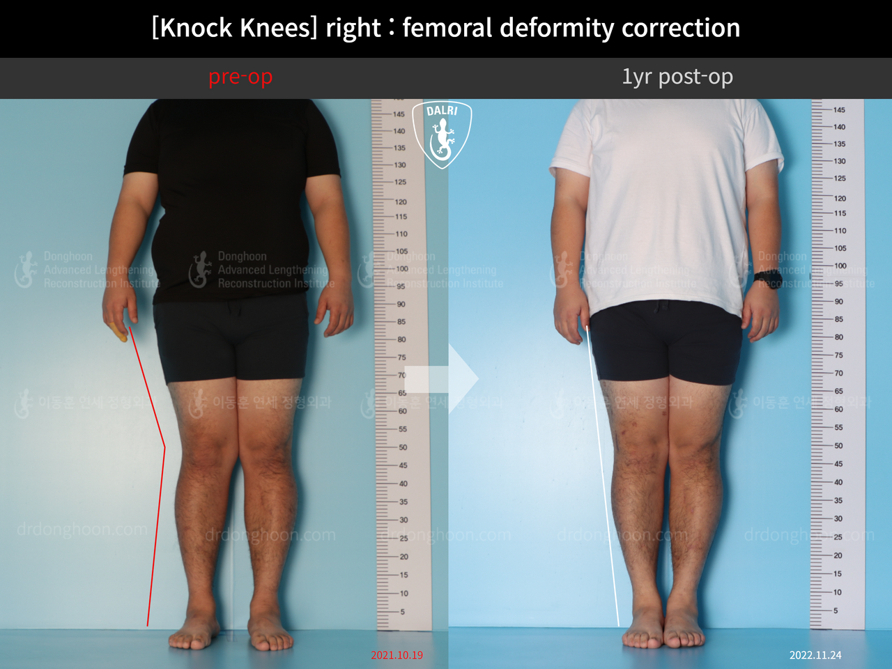 Before and after adult knock knees, case 13582115, image 1, Dr. Donghoon institute (DALRI)