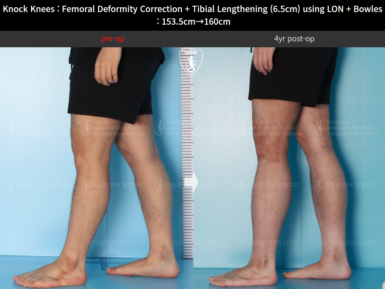 Before and after cll + deformity correction, case 16723810, image 8, Dr. Donghoon institute (DALRI)